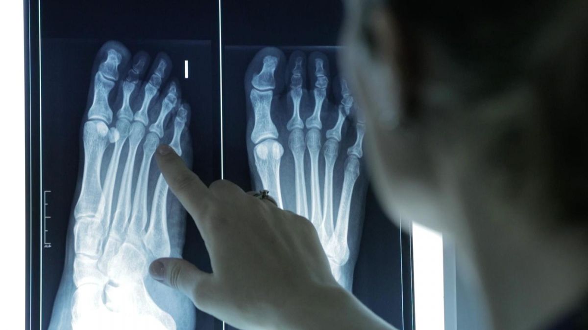 Radiografia d'un peu en una imatge d'arxiu (Foto: ICOPCV) Radiografia d'un peu en una imatge d'arxiu (Foto: ICOPCV)